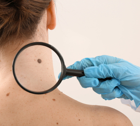 Lunares o nevus melanocíticos