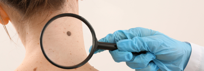 Lunares o nevus melanocíticos