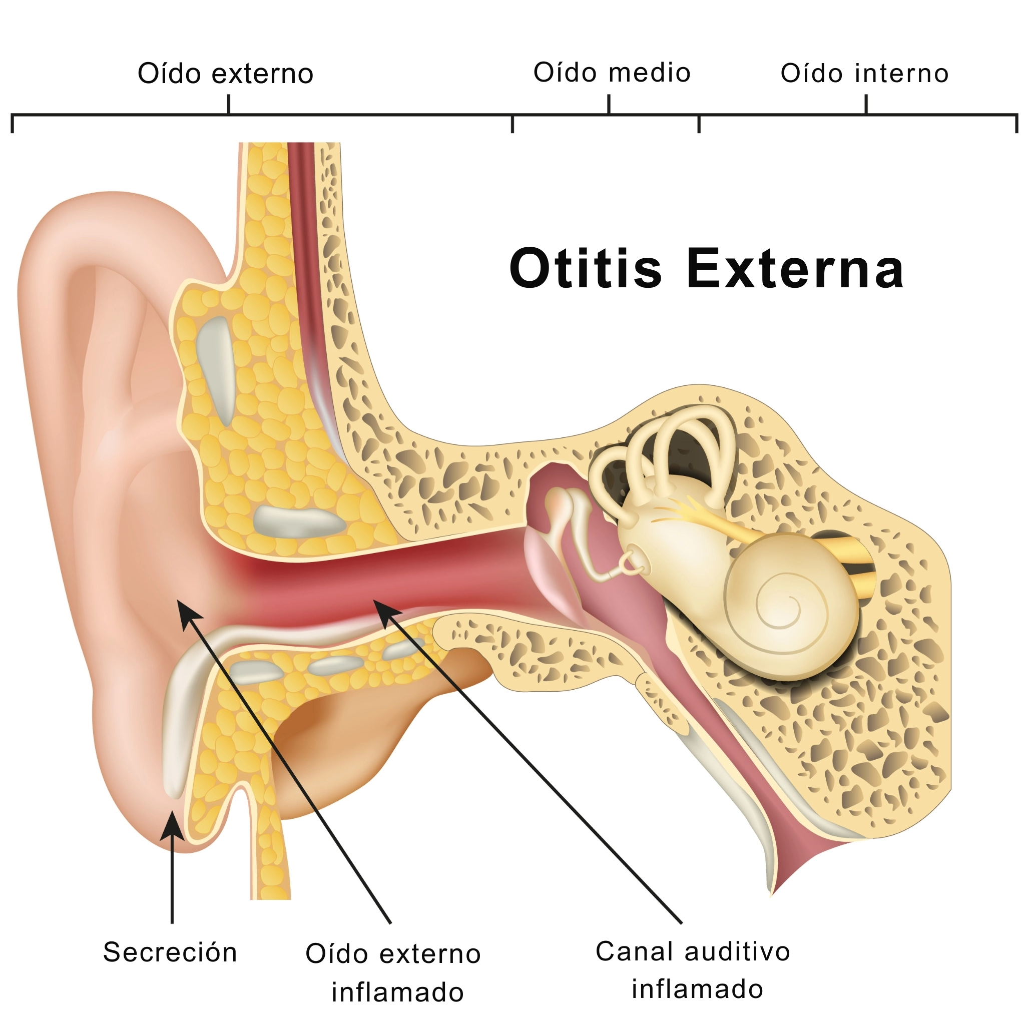 ilustración otitis externa