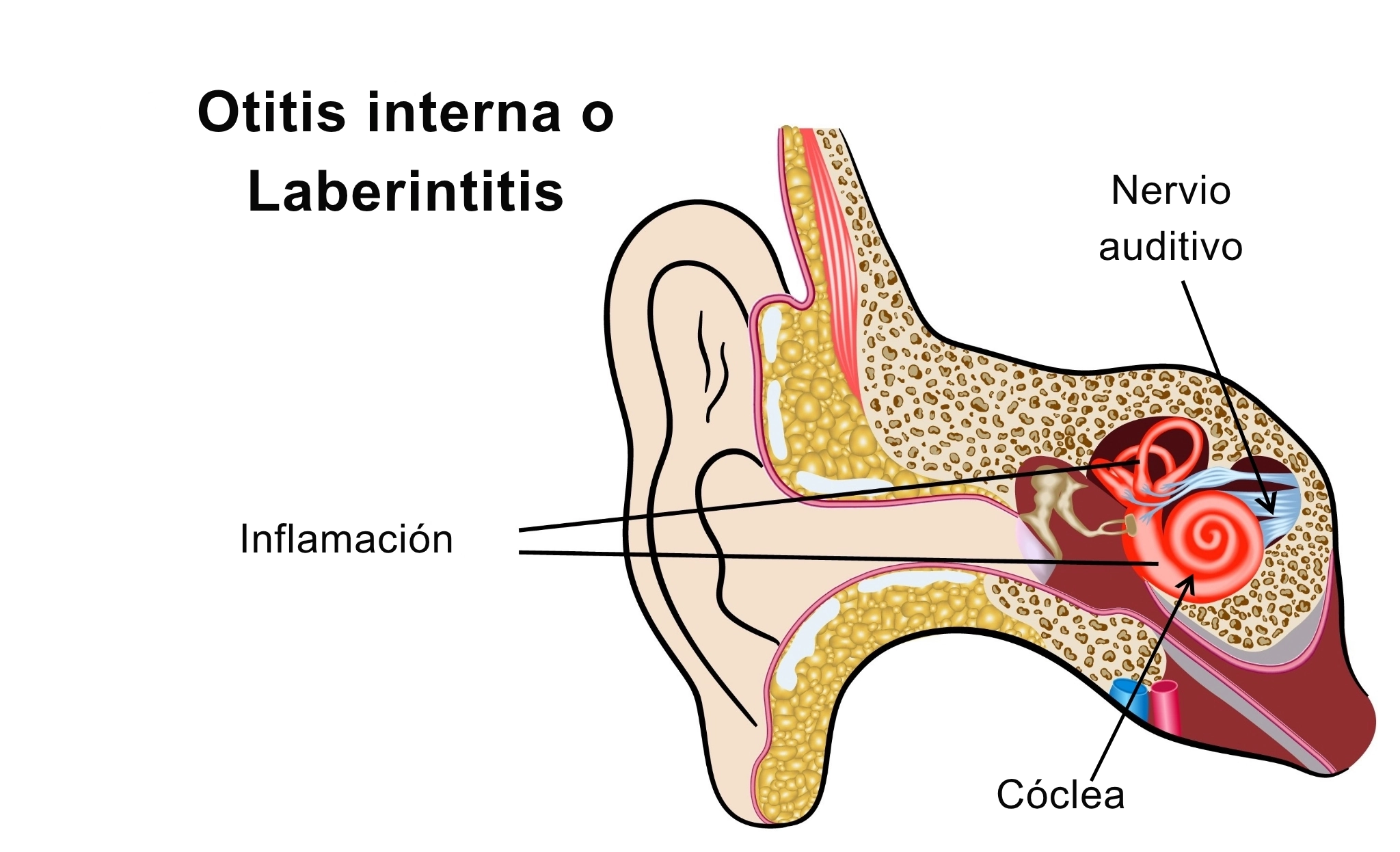ilustración otitis interna