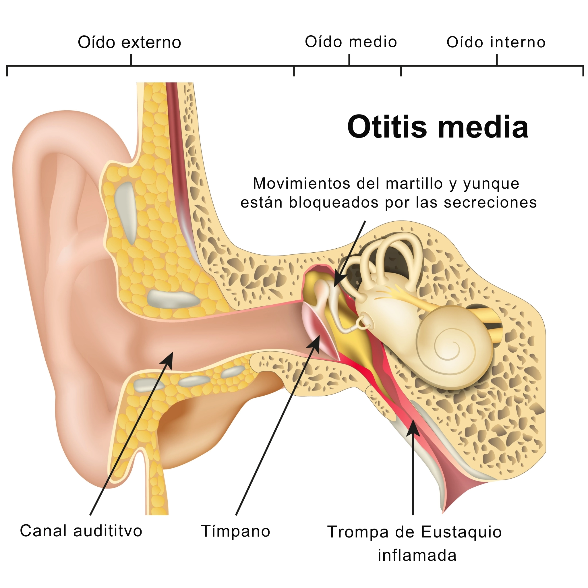 ilustración otitis media