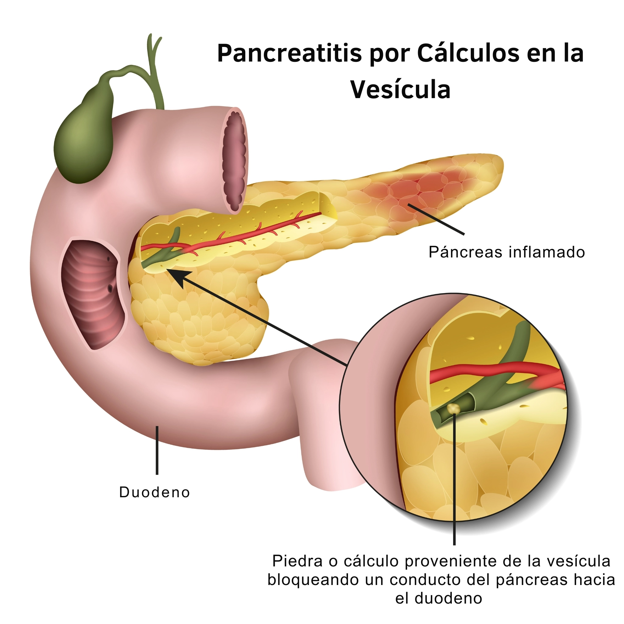 ilustración médica que explica pancreatitis por cálculo en la vesícula