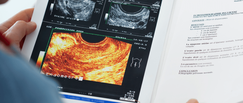 ECOGRAFIA TRANSVAGINAL O TRANSRECTAL