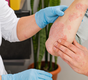 persona con psoriasis en una consulta médica