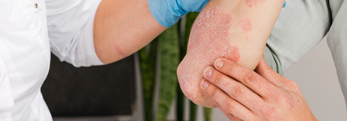 persona con psoriasis en una consulta médica
