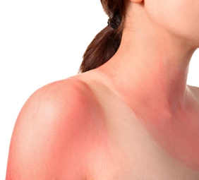persona con una quemadura solar 