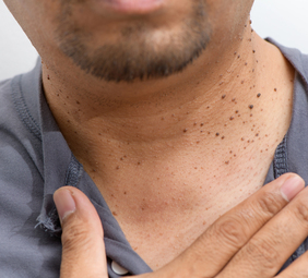 persona con queratosis en el cuello