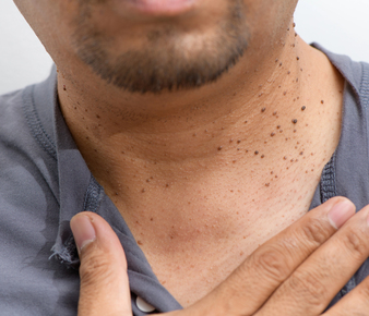 persona con queratosis en el cuello