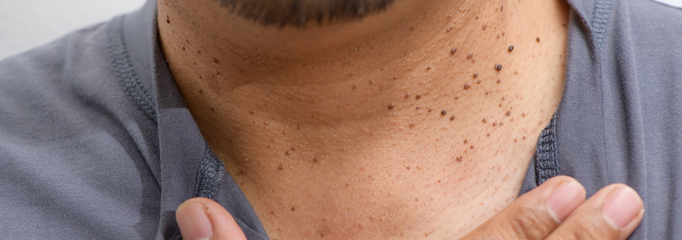 persona con queratosis en el cuello