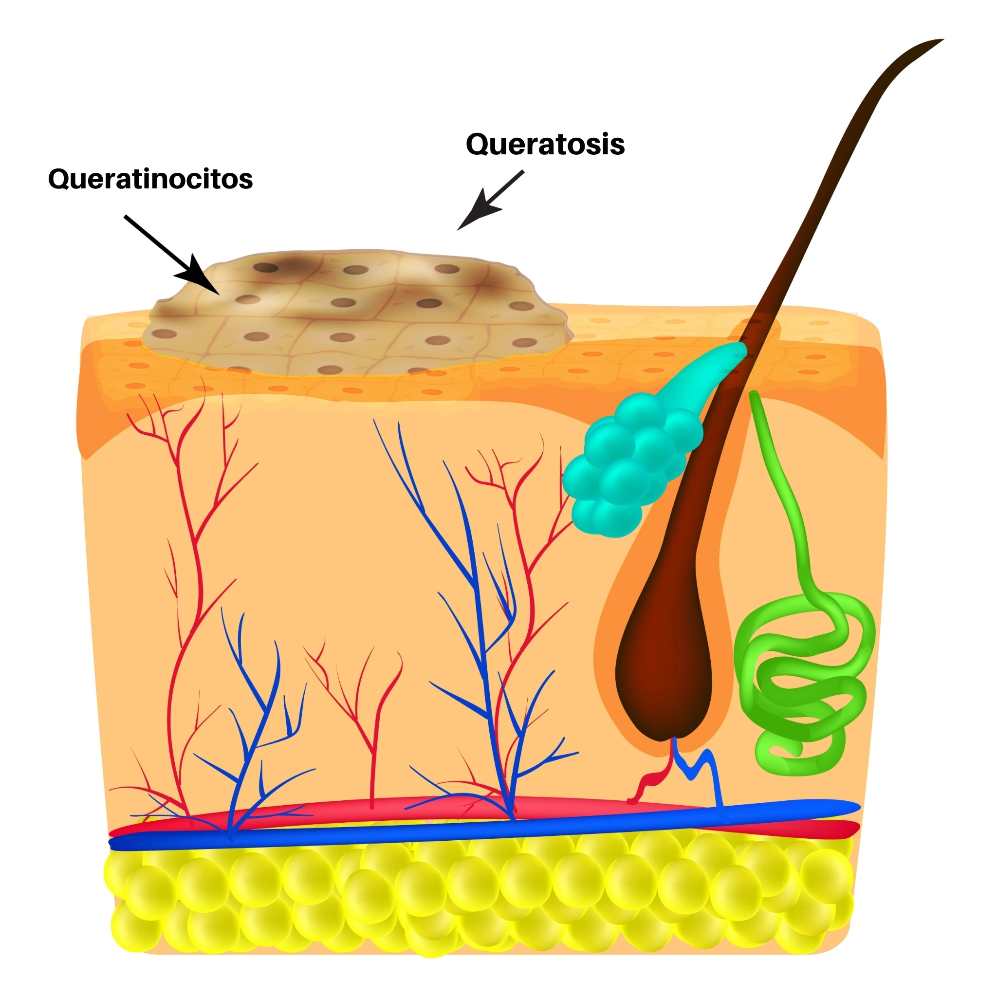 Ilustración médica que muestra la queratosis en la piel