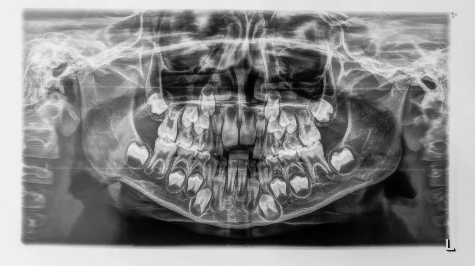radiografía del maxilar de un niño, con dientes de leche y arriba los definitivos