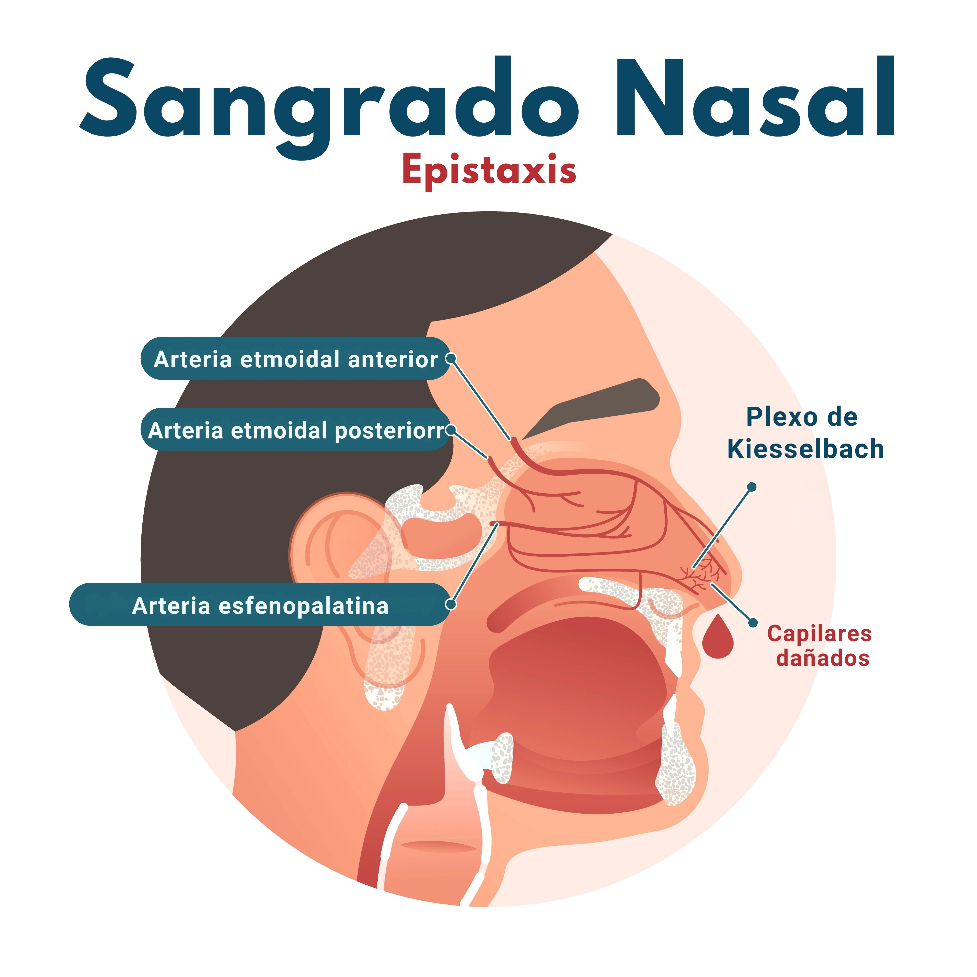 Ilustración que muestra cómo ocurre el sangrado nasal o epistaxis