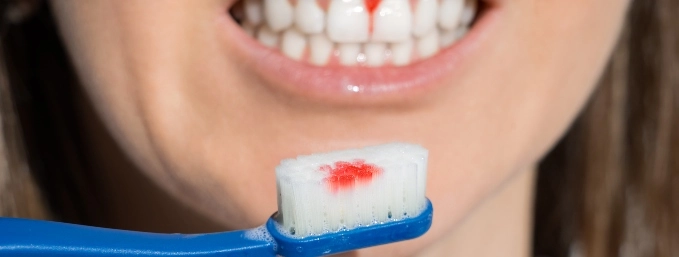 mujer muestra dientes con sagrado de encías y cepillo dental con manchas de sangre