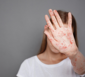 Persona con sarampion mostrando la palma de la mano con pintas rojas en señal de detención
