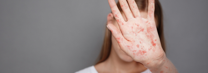 Persona con sarampion mostrando la palma de la mano con pintas rojas en señal de detención