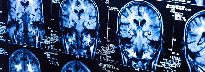Scanner cerebral