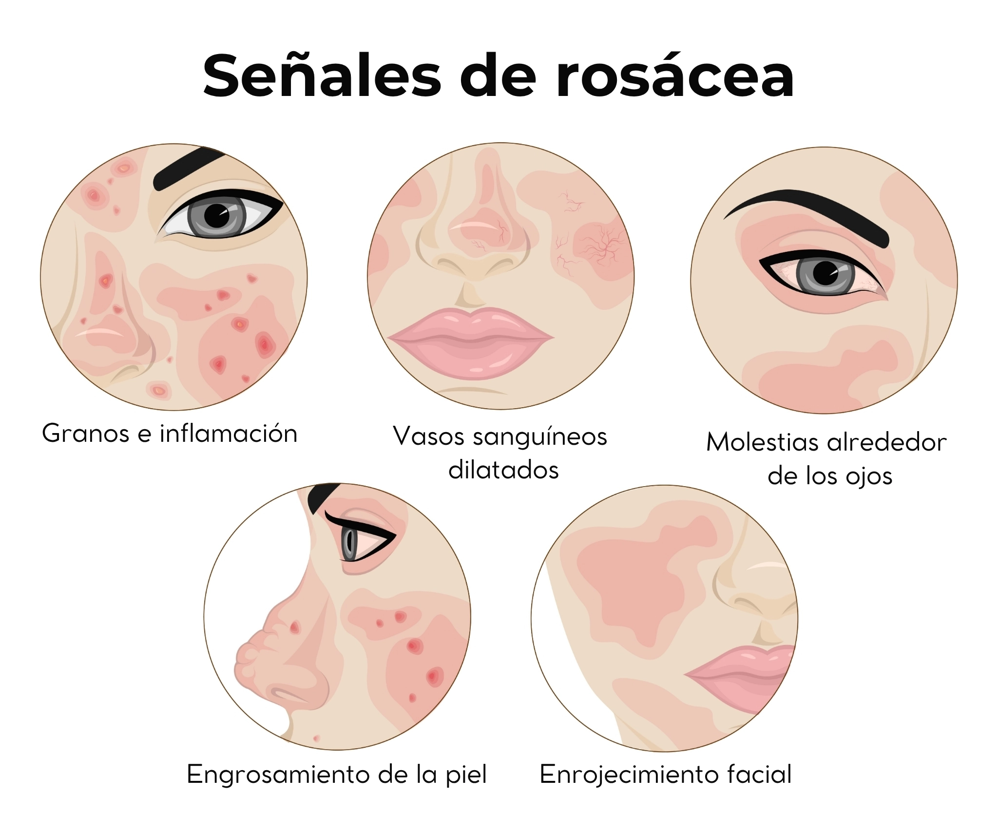 ilustración que muestra señales de rosácea