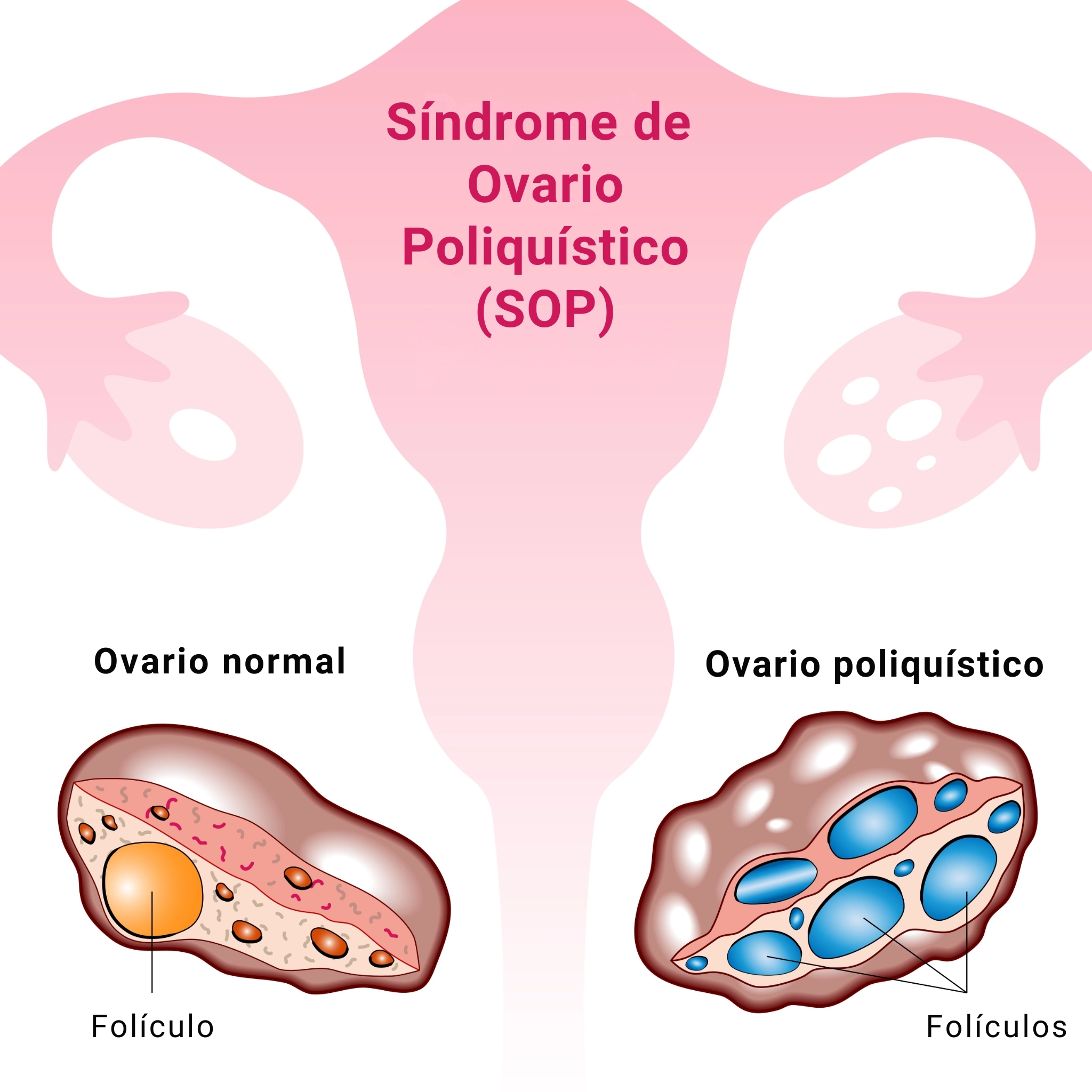 Ilustración que muestra estado de los óvulos en el síndrome de ovario poliquístico (SOP)
