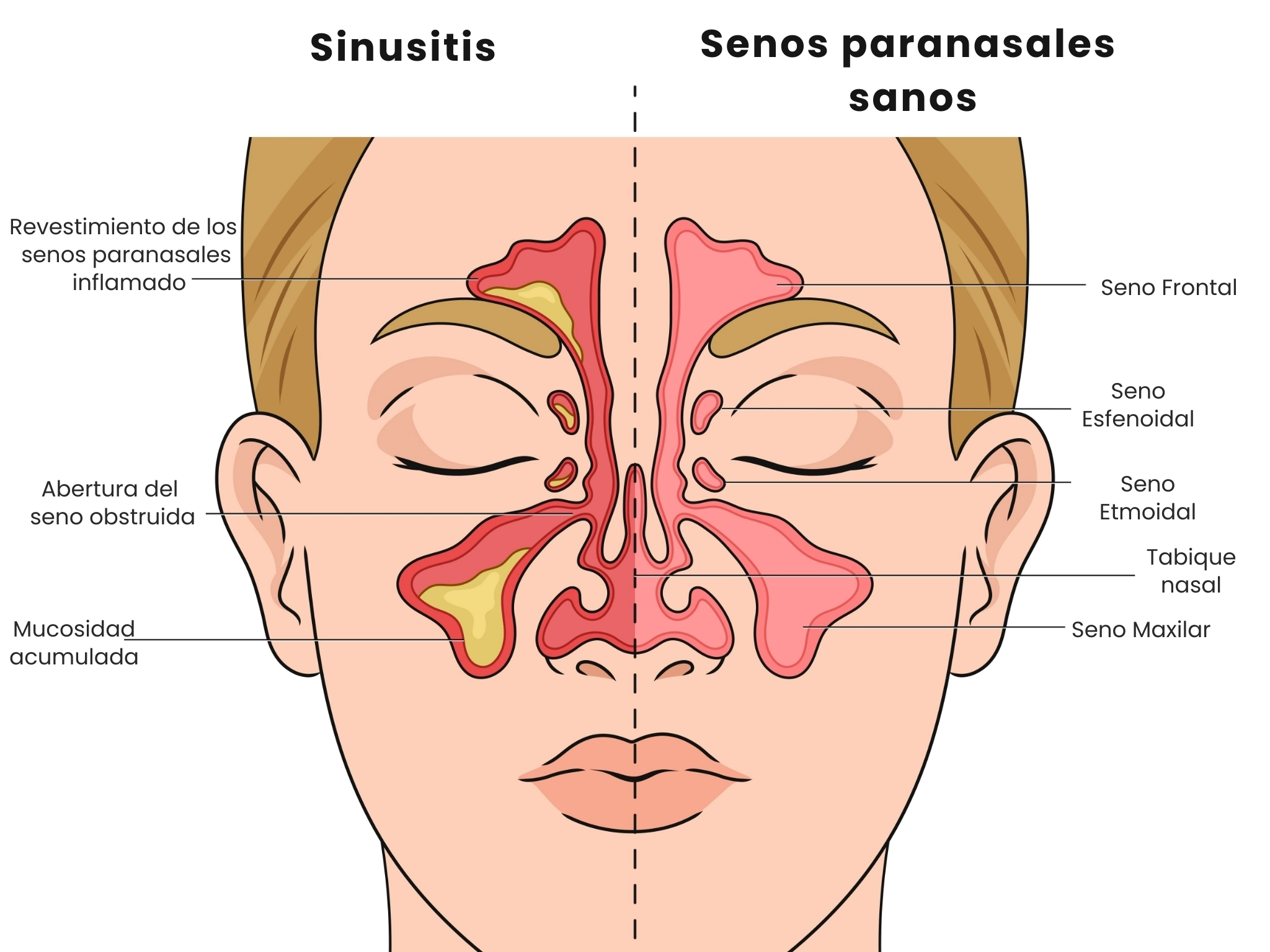 Ilustración médica de la sinusitis