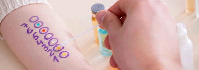 brazo marcado con números y frascos con sustancias de colores para hacer prick test o test de alergia