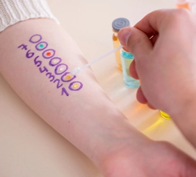 brazo marcado con números y frascos con sustancias de colores para hacer prick test o test de alergia