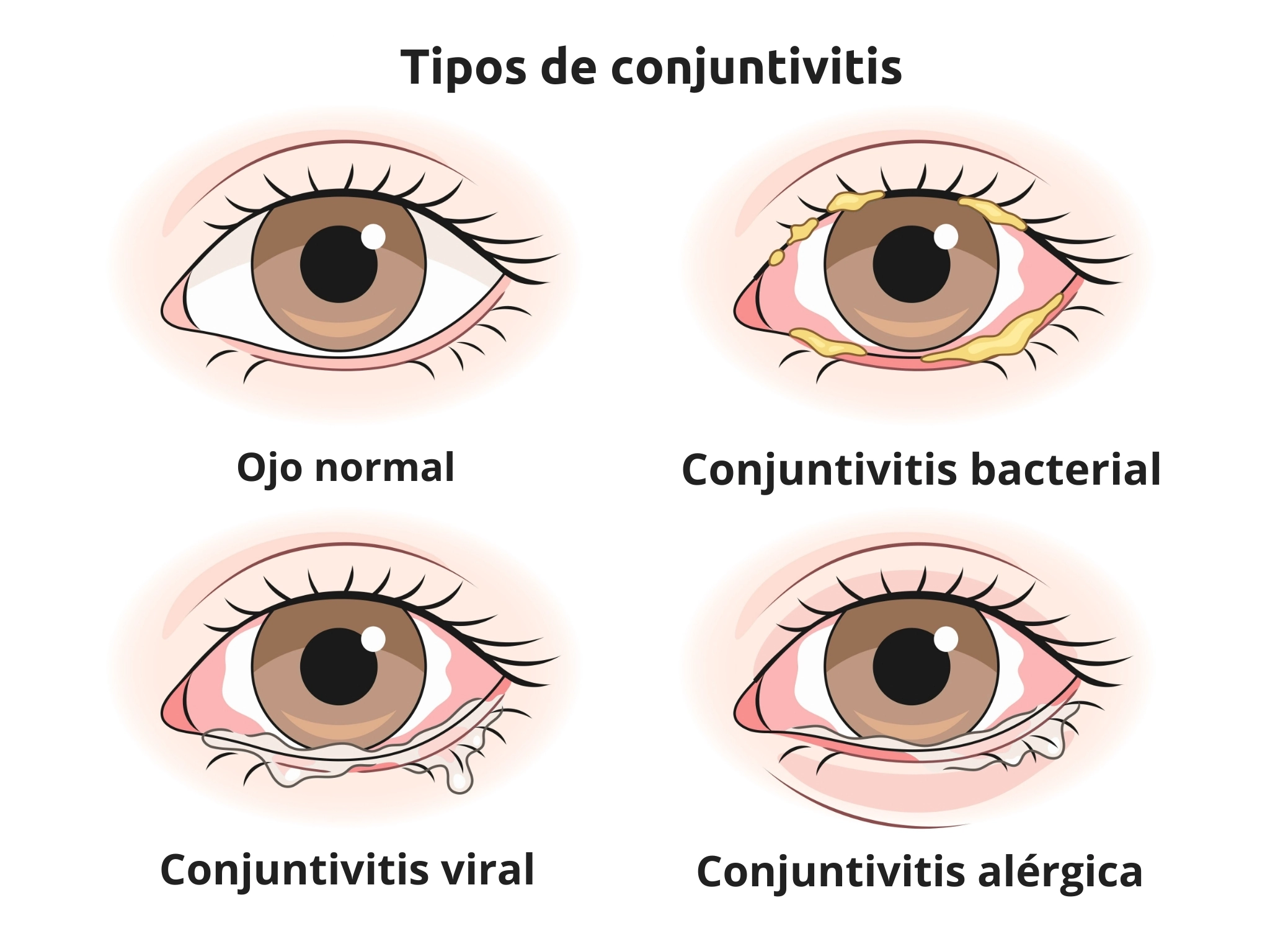 ilutración que muestra los tipos de conjuntivitis ocular