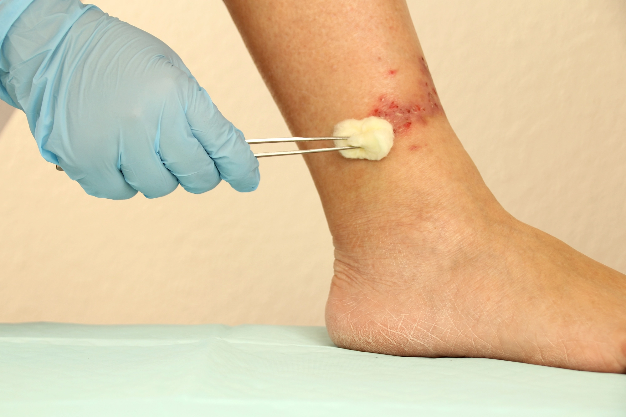 personal médico limpiando una úlcera en la piel a la altura del tobillo
