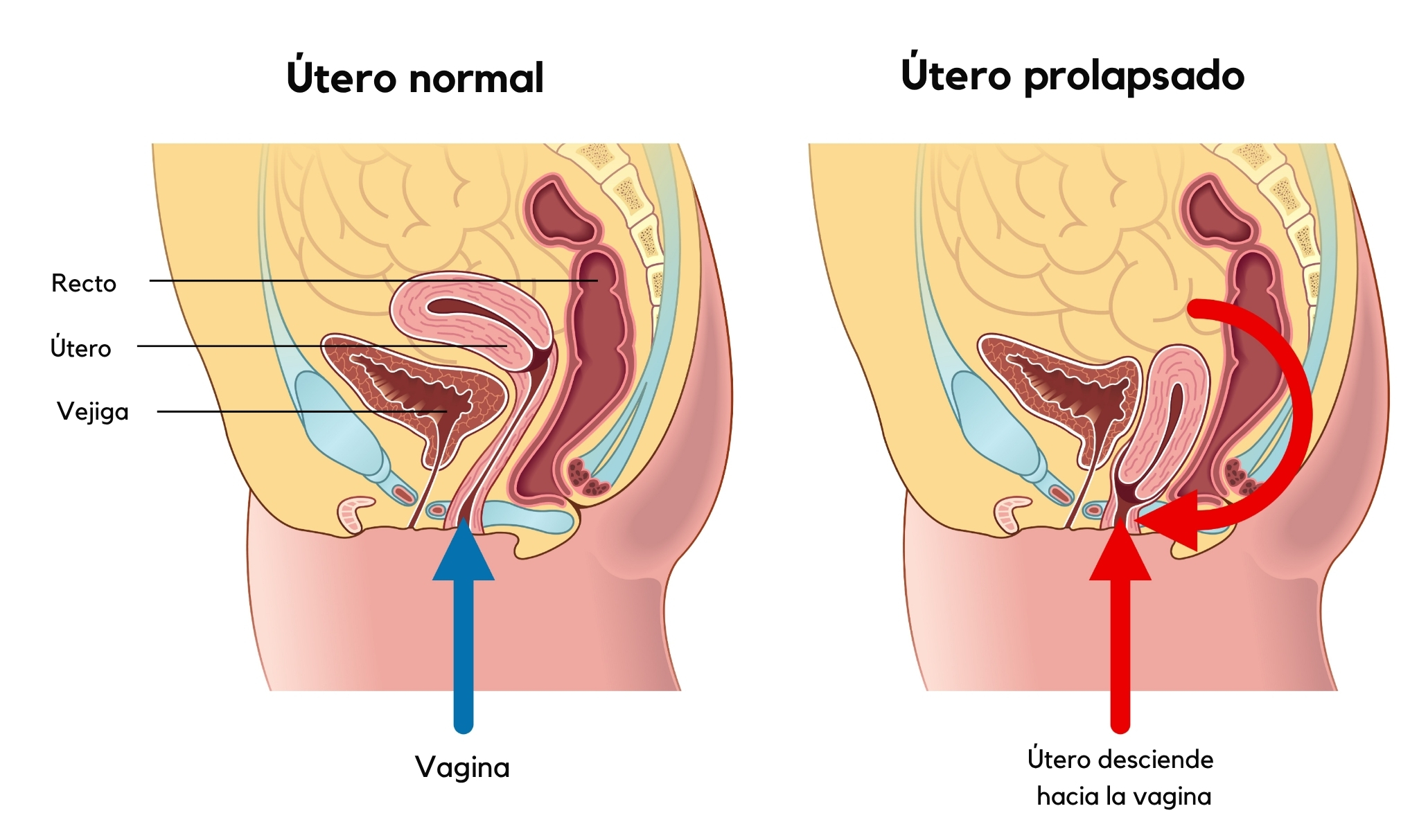 ilustración médica que muestra el prolapso uterino