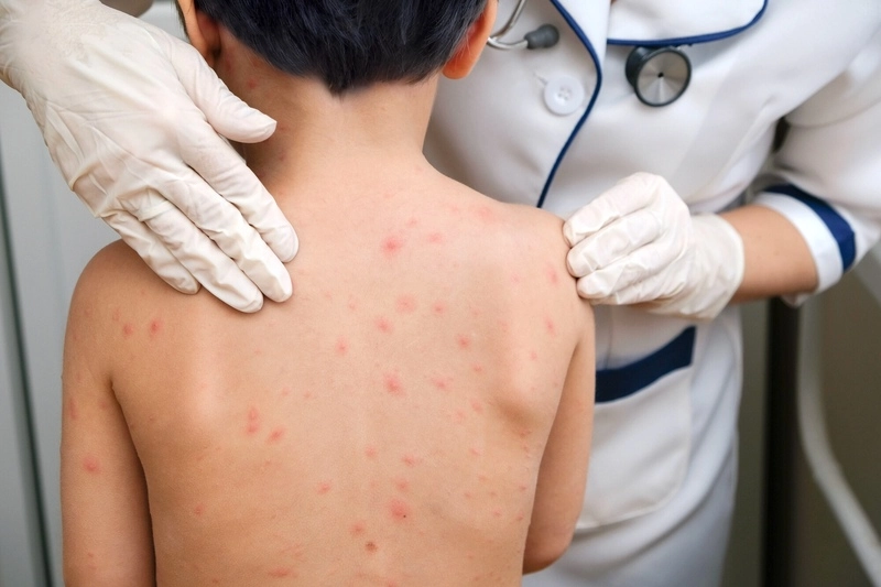 Niño con marcas de varicela en la espalda siendo examinado por médico pediatra